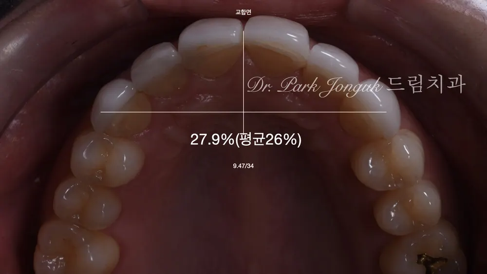 生硬不透明的前牙瓷贴面再治疗 — 图3