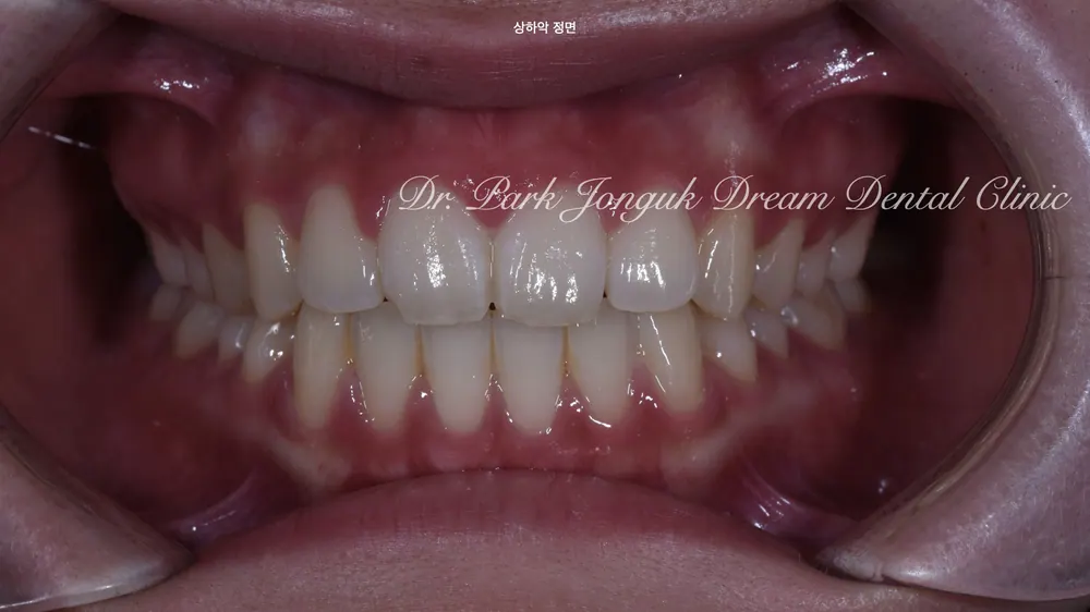 Ca điều trị veneer răng cửa tại nha khoa gần ga Apgujeong — ảnh 2