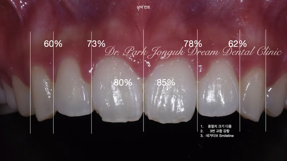 Ca điều trị veneer răng cửa tại nha khoa gần ga Apgujeong — ảnh 4