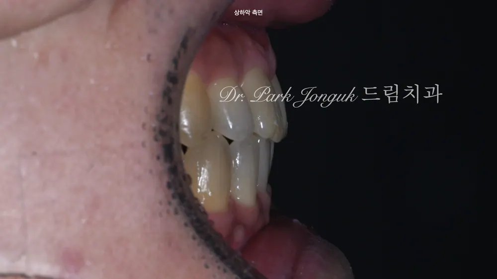 기울어진 치아의 앞니 라미네이트 치료 본문 사진 4