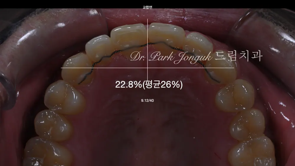 기울어진 치아의 앞니 라미네이트 치료 본문 사진 5
