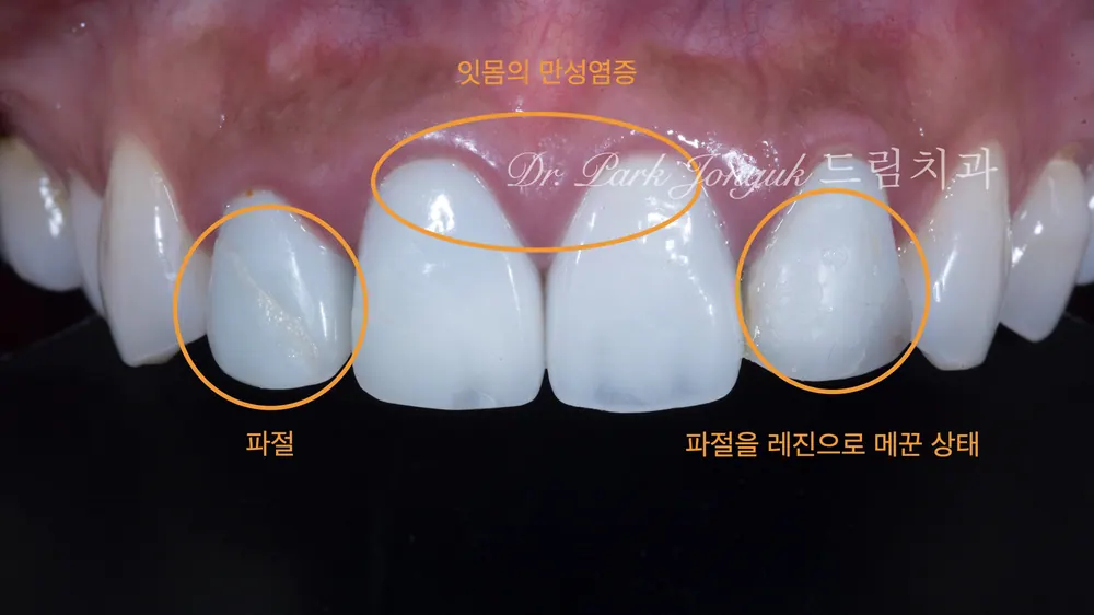 신사동치과 올세라믹 크라운의 재시술 본문 사진 2