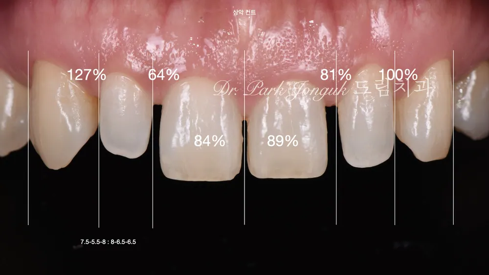Veneer tại Sinsa-dong: điều trị veneer cho răng cửa thưa — ảnh 2