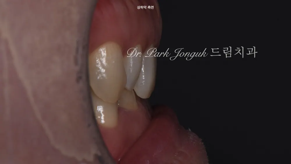 Veneer tại Sinsa-dong: điều trị veneer cho răng cửa thưa — ảnh 3