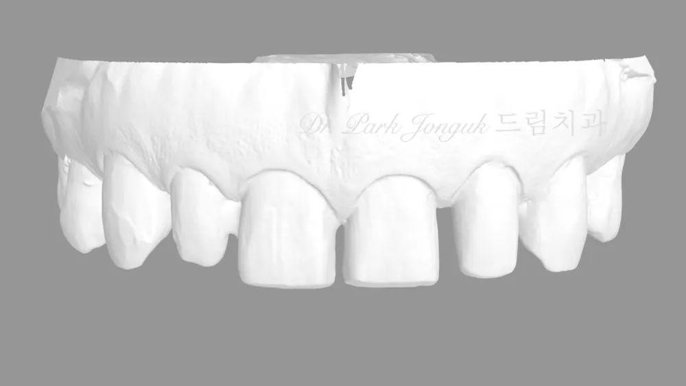 Veneer tại Sinsa-dong: điều trị veneer cho răng cửa thưa — ảnh 5