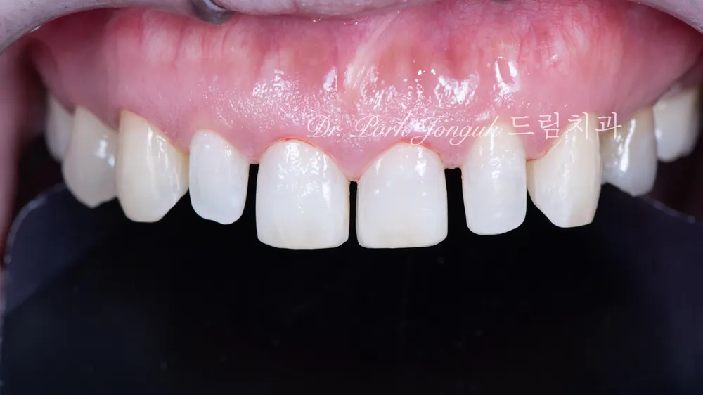 Veneer tại Sinsa-dong: điều trị veneer cho răng cửa thưa — ảnh 6