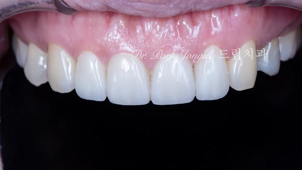 Veneer tại Sinsa-dong: điều trị veneer cho răng cửa thưa — ảnh 7