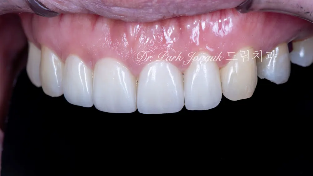 Veneer tại Sinsa-dong: điều trị veneer cho răng cửa thưa — ảnh 9