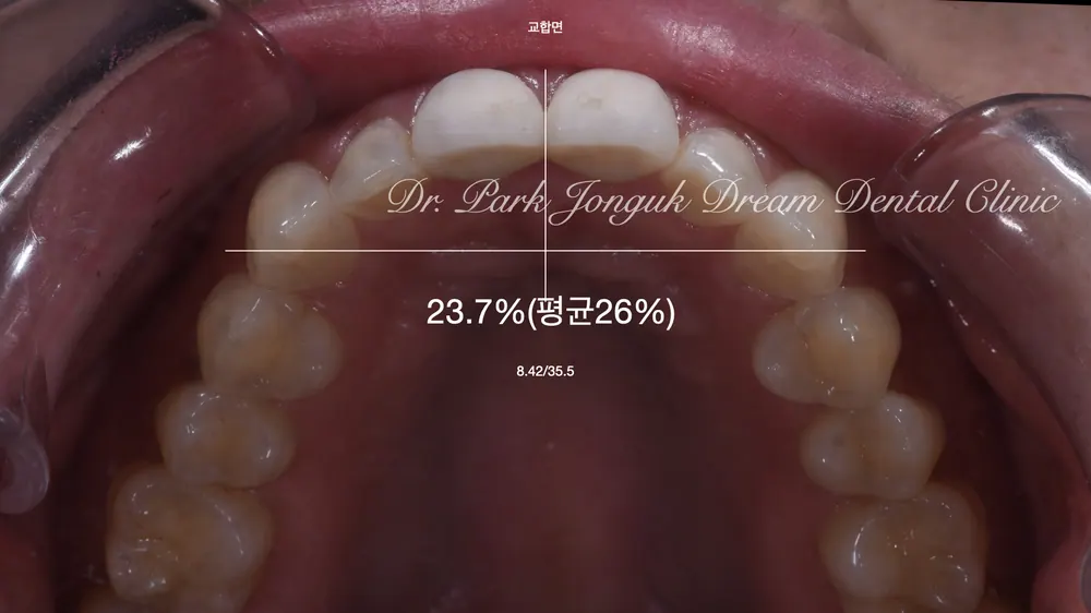 自然前牙陶瓷貼片，全瓷冠重做 — 圖4