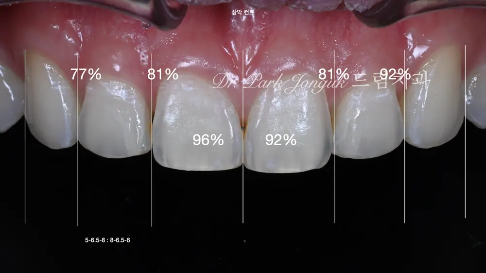 Cách giảm thiểu tác dụng phụ của veneer không mài răng — ảnh 2