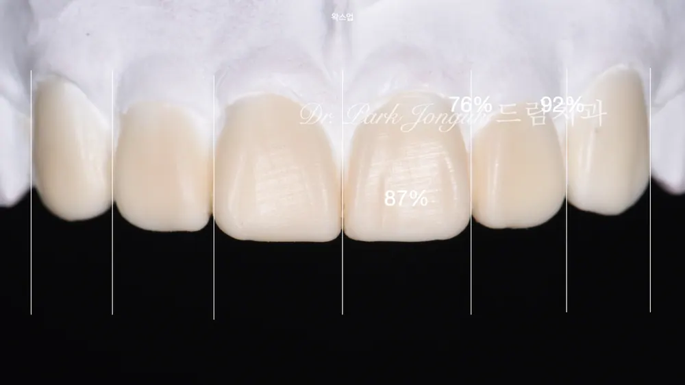 Cách giảm thiểu tác dụng phụ của veneer không mài răng — ảnh 5