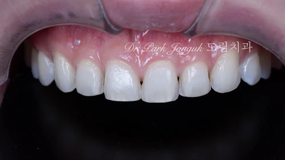 Cách giảm thiểu tác dụng phụ của veneer không mài răng — ảnh 6