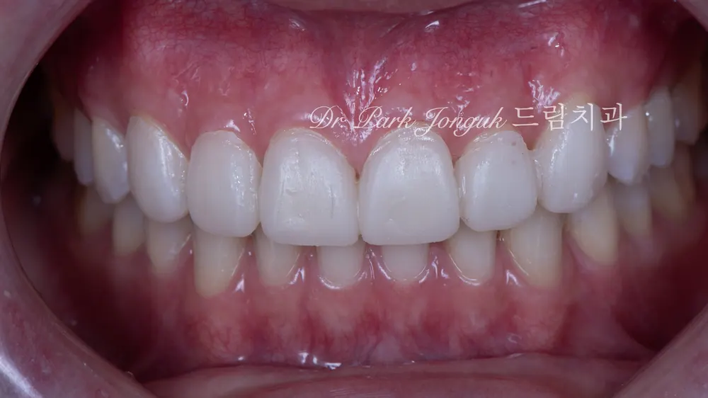 Cách giảm thiểu tác dụng phụ của veneer không mài răng — ảnh 7