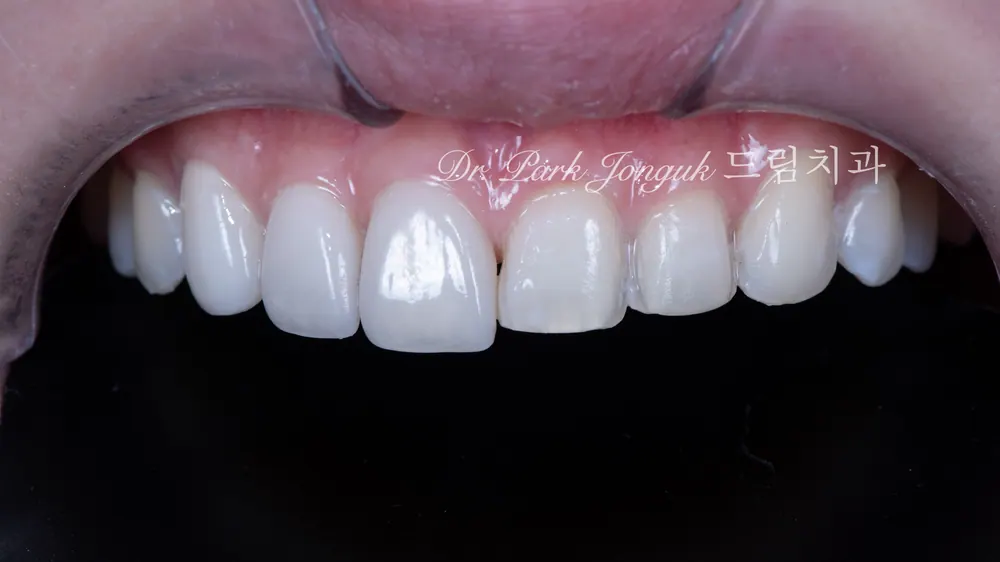 Cách giảm thiểu tác dụng phụ của veneer không mài răng — ảnh 8