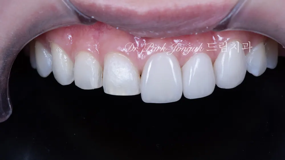 Cách giảm thiểu tác dụng phụ của veneer không mài răng — ảnh 9