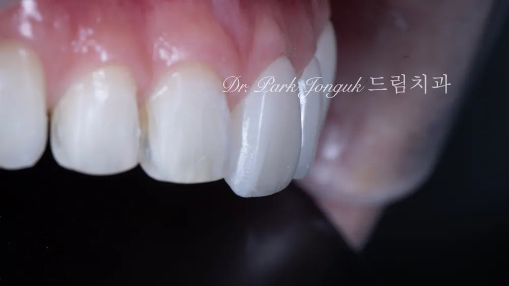 Cách giảm thiểu tác dụng phụ của veneer không mài răng — ảnh 10