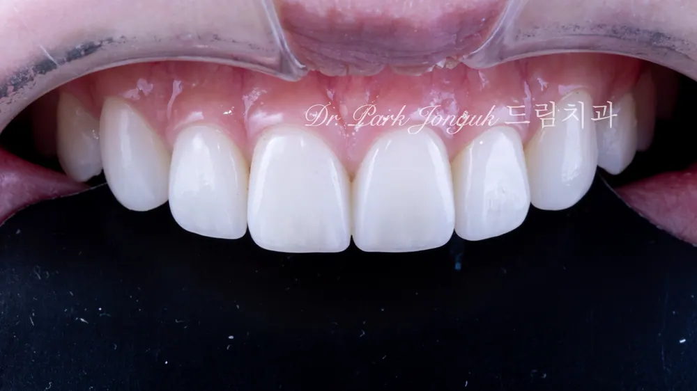 Cách giảm thiểu tác dụng phụ của veneer không mài răng — ảnh 11