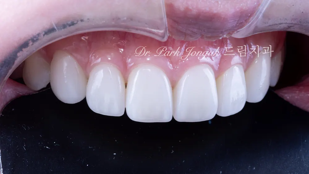 Cách giảm thiểu tác dụng phụ của veneer không mài răng — ảnh 12