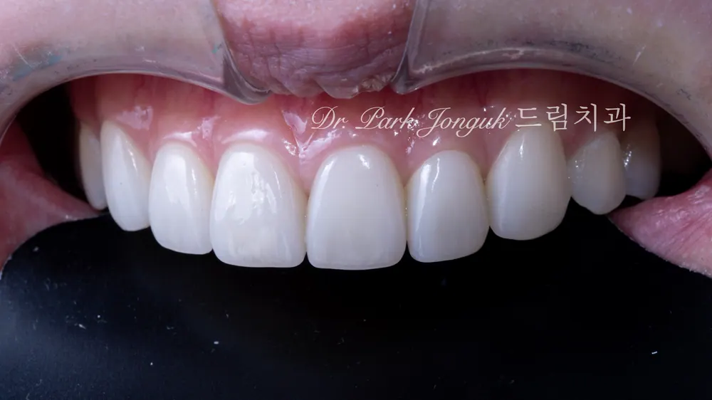 Cách giảm thiểu tác dụng phụ của veneer không mài răng — ảnh 13