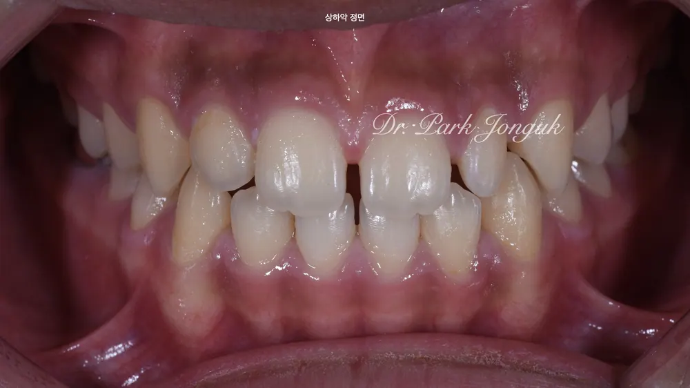 Celebrity Veneers: A Natural Result with No-Prep Treatment — photo 1