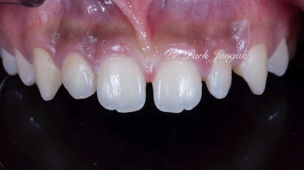 Celebrity Veneers: A Natural Result with No-Prep Treatment — photo 2