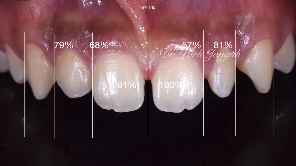 Celebrity Veneers: A Natural Result with No-Prep Treatment — photo 3