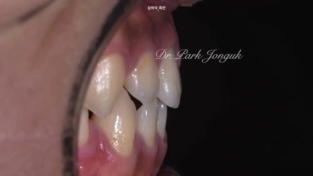 Celebrity Veneers: A Natural Result with No-Prep Treatment — photo 4
