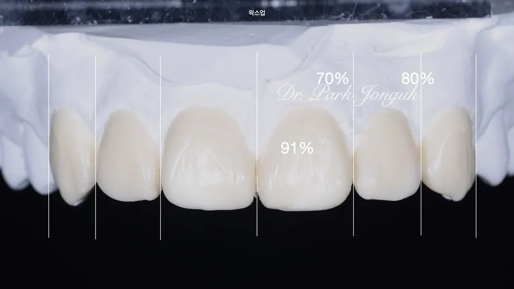 Celebrity Veneers: A Natural Result with No-Prep Treatment — photo 5