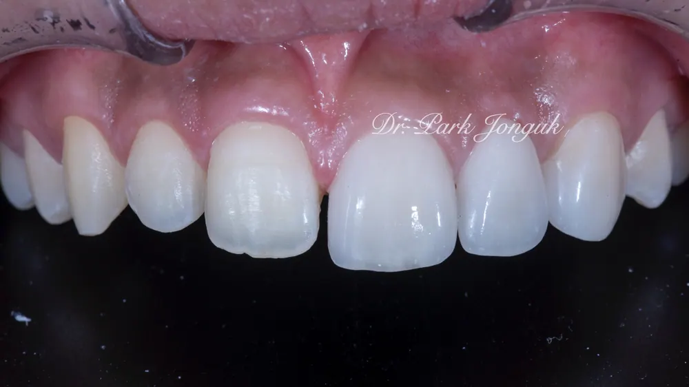 Celebrity Veneers: A Natural Result with No-Prep Treatment — photo 6