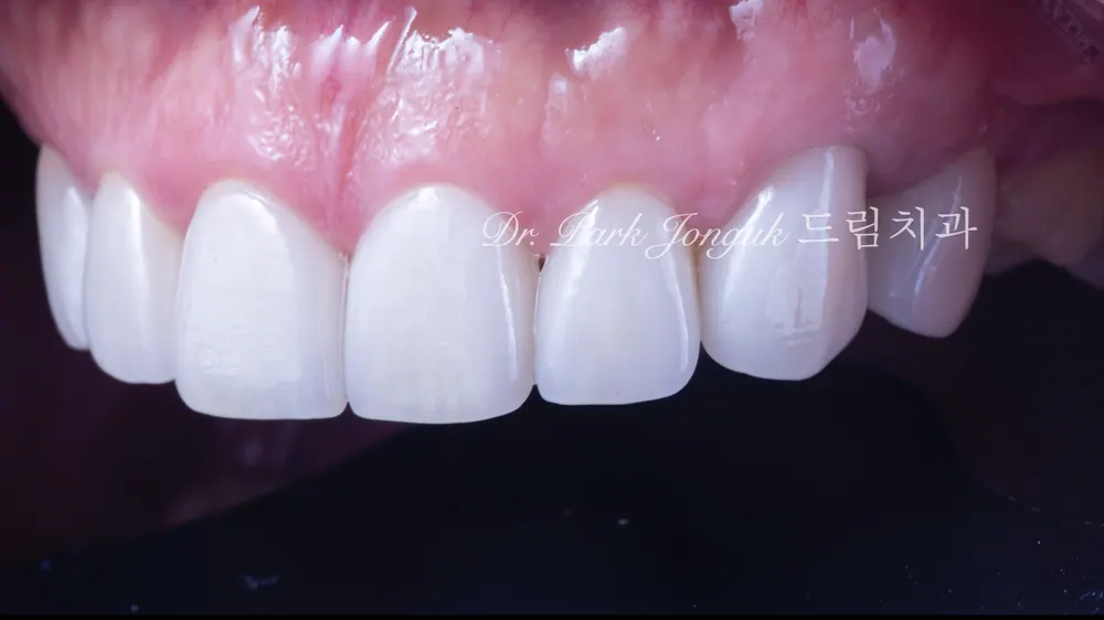 심한 마모 치아에 대한 라미네이트 치료 본문 사진 8