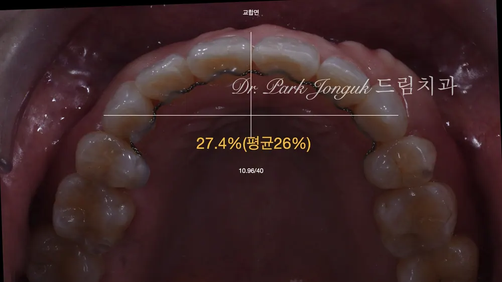앞니 라미네이트 자연스러운 치아의 모양으로 본문 사진 3