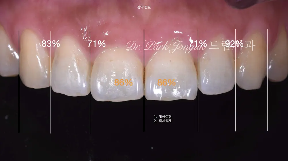 압구정치과 무삭제 라미네이트 잘하는 곳 본문 사진 2