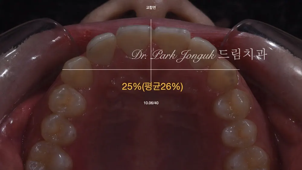 자연스럽게 라미네이트 재시술하기 본문 사진 4