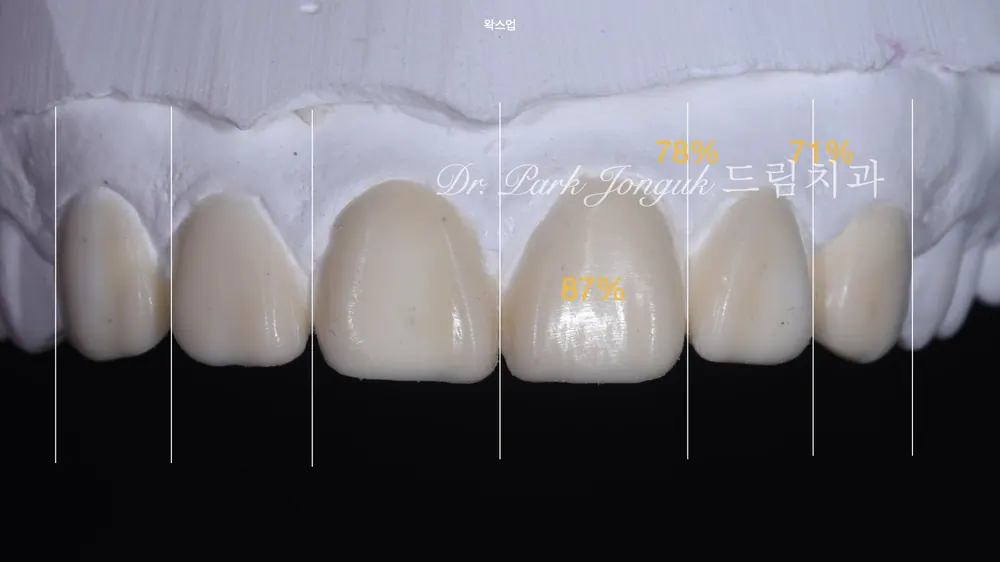 자연스럽게 라미네이트 재시술하기 본문 사진 5