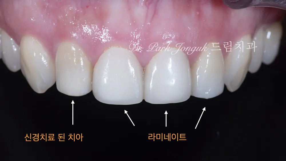 新沙洞の歯科、自然な質感でのラミネートベニア再治療 — 写真2