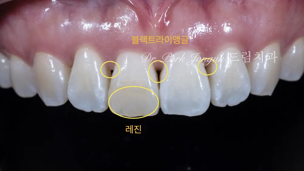 블랙트라이앵글의 앞니 라미네이트 치료 본문 사진 2