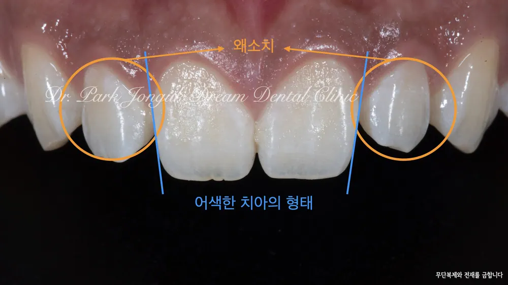청담동치과 무삭제 라미네이트로 자연스럽게 본문 사진 2