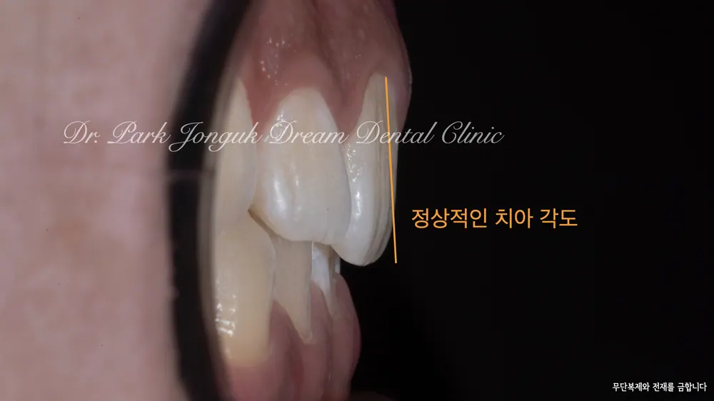 청담동치과 무삭제 라미네이트로 자연스럽게 본문 사진 3