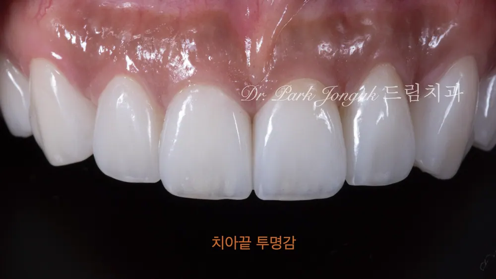 Dán sứ Veneer răng cửa chỉnh sửa hình dáng và cách sắp xếp răng — ảnh 4
