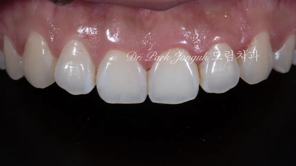 A No-Prep Veneer Case at a Clinic Skilled in Veneers — photo 1