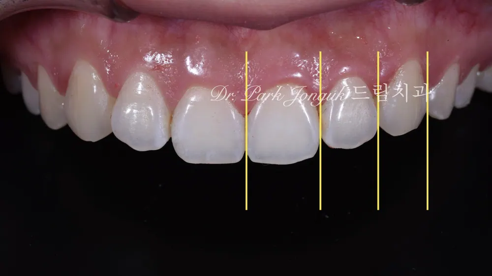 A No-Prep Veneer Case at a Clinic Skilled in Veneers — photo 2
