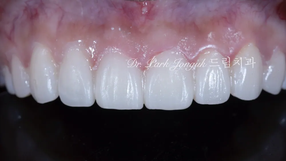 A No-Prep Veneer Case at a Clinic Skilled in Veneers — photo 6