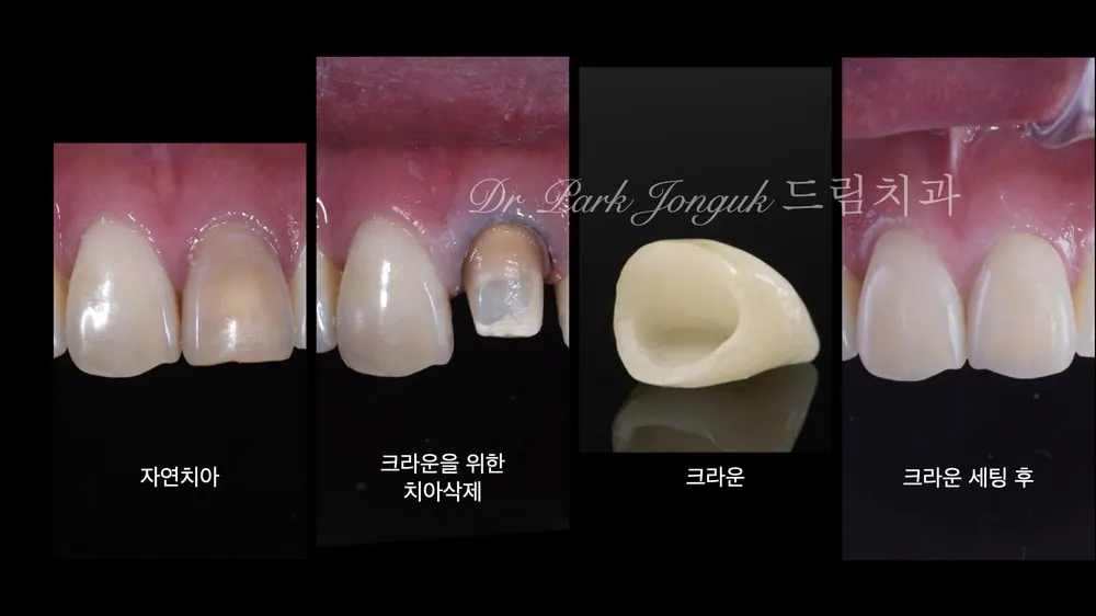 라미네이트치과 올세라믹 크라운 재시술 본문 사진 2