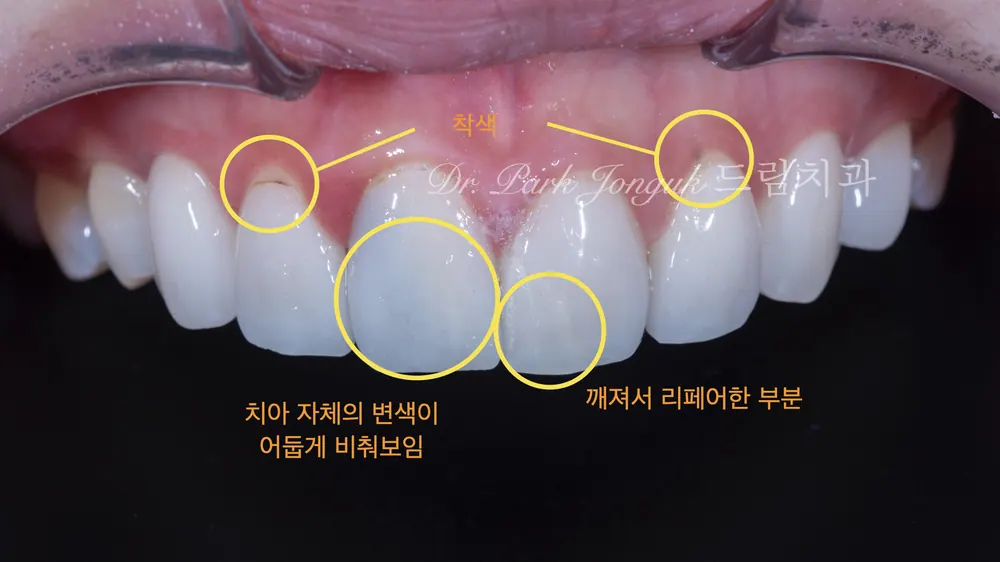 라미네이트치과 올세라믹 크라운 재시술 본문 사진 4