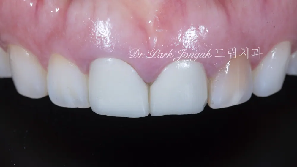 압구정라미네이트 치아 손상을 최소화한 시술 본문 사진 1