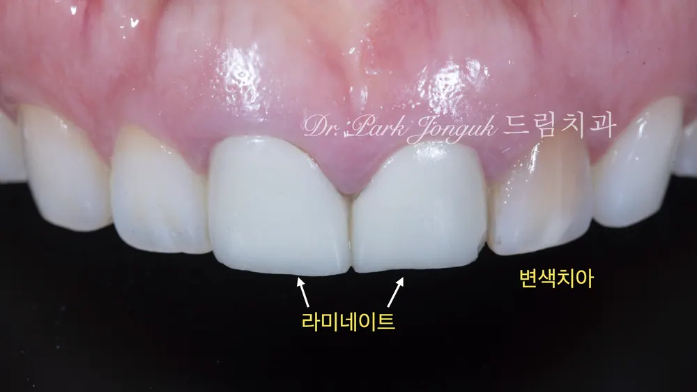 압구정라미네이트 치아 손상을 최소화한 시술 본문 사진 2