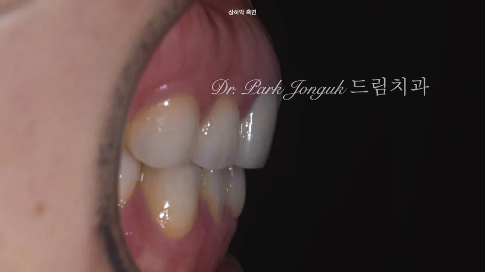 압구정라미네이트 치아 손상을 최소화한 시술 본문 사진 4