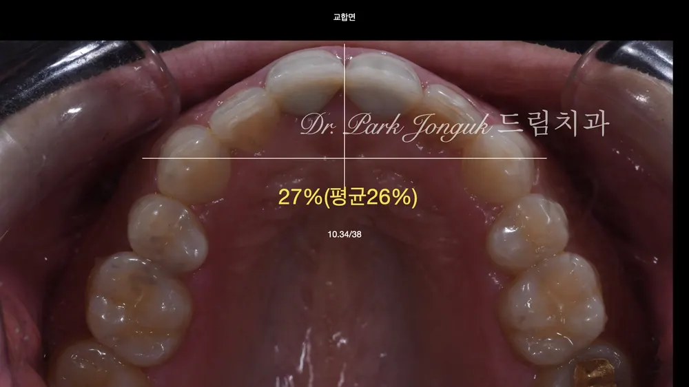 압구정라미네이트 치아 손상을 최소화한 시술 본문 사진 5