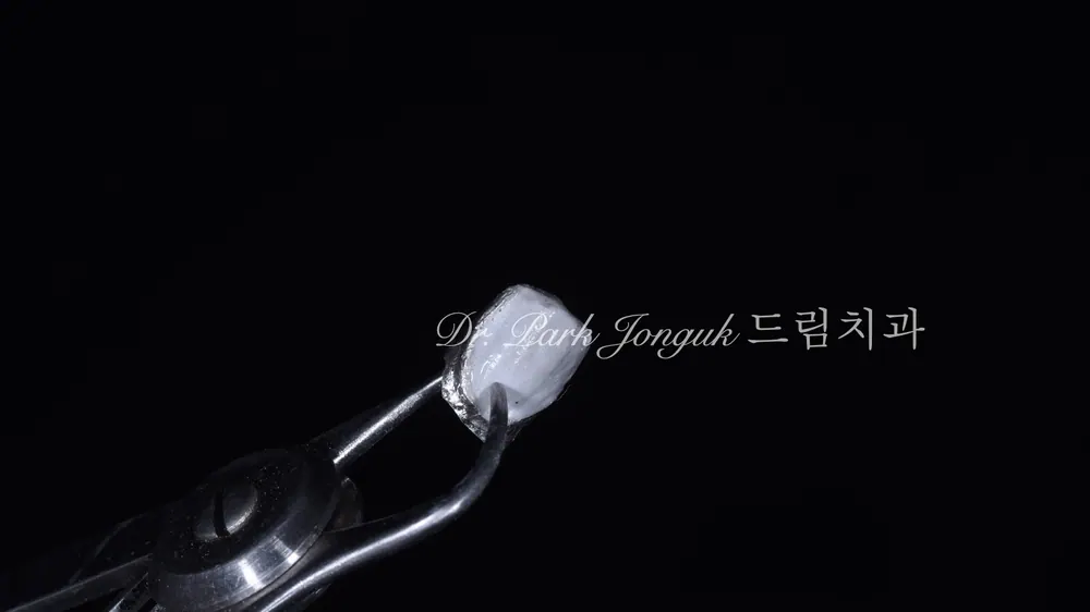 압구정라미네이트 치아 손상을 최소화한 시술 본문 사진 10