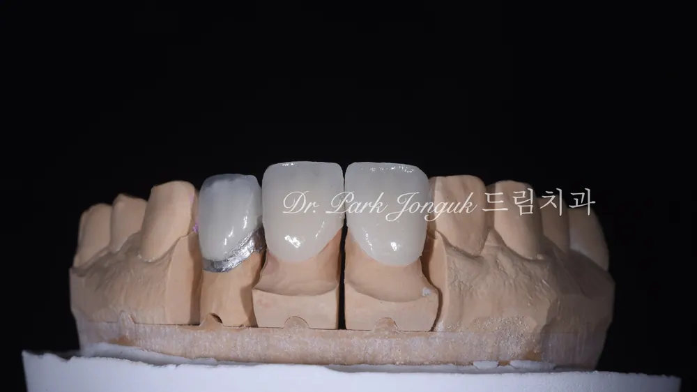 압구정라미네이트 치아 손상을 최소화한 시술 본문 사진 14